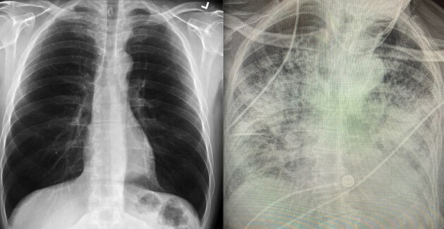 Schokkende foto’s: longen van coronapatiënt nóg slechter dan rokerslongen